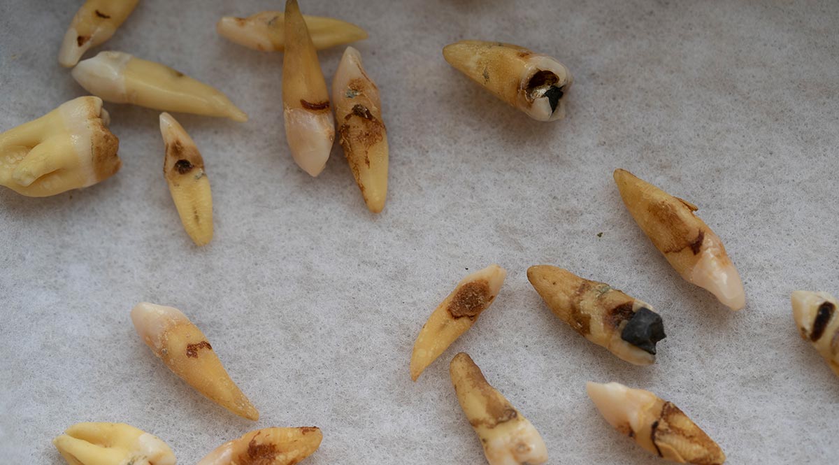 Would you like to have a smile like a Neanderthal? You might after this. According to Laura Weyrich, PhD, Neanderthals had surprisingly good oral microbiomes. She studies ancient teeth togain insights into modern dental health.